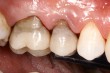 Alcune nostre realizzazioni - 3D Tecnologie Dentali