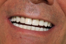 Zirconia monolitica traslucente - 3D Tecnologie Dentali